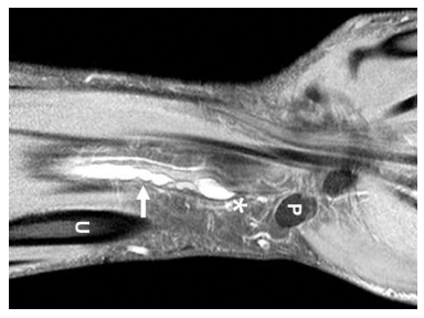 X-ray의 한계와 초음파 정밀 진단 — 손목·발목 결절종 위치 확인