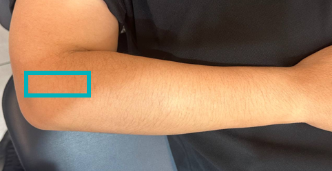 팔꿈치 바깥쪽 통증, 안쪽 엘보 파열, 프롤로테라피? 핵심은 '힘줄 재생'입니다