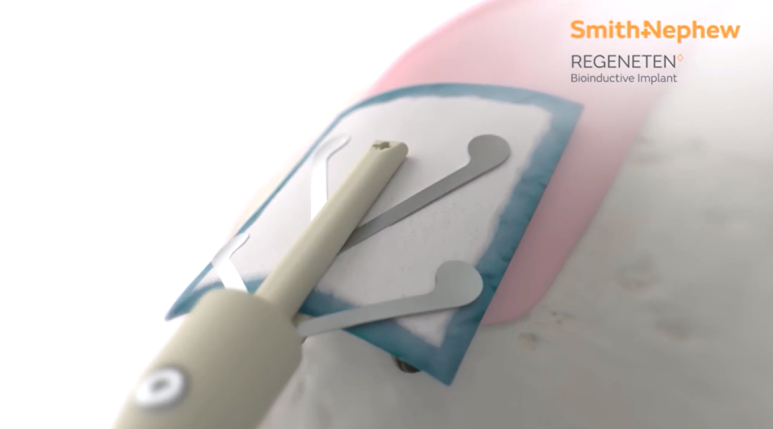 회전근개 부분 파열, 전층 파열? 리제네텐 Regeneten 효과 <종결편>