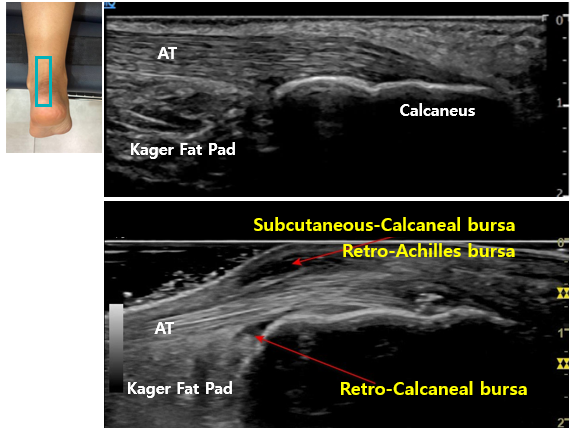 아킬레스건 점액낭염, 골극, 석회성 건염, 뒤꿈치 통증? <이것> 먼저 확인해야 합니다!
