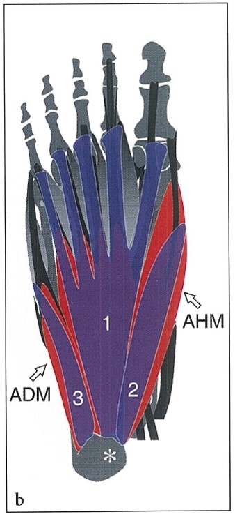족저근막염의 진단과 도침(침도) 치료, 화곡역 한의원