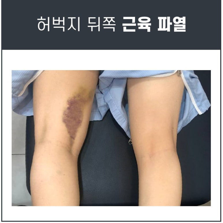 허벅지 뒤쪽 통증, 햄스트링 파열 주의하세요!