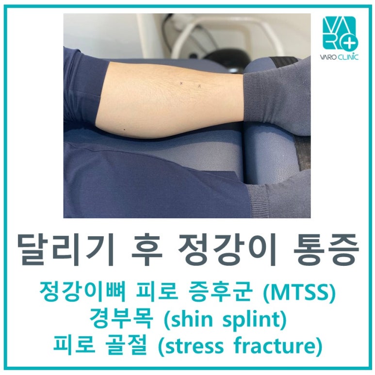 달리기 후 정강이 앞쪽 통증 (피로 골절, shin-splint)
