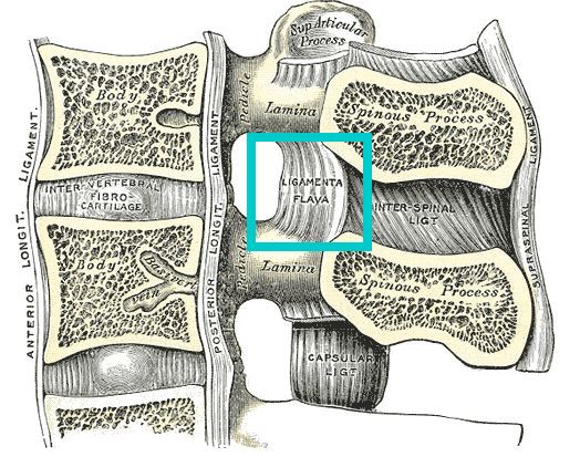 요추 척추관 협착증 도침, 침도치료 (황색인대 비후)