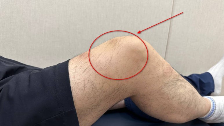 무릎 물찼을때 염증 증상 운동 물빼기? <실제 치료사례> 공개합니다