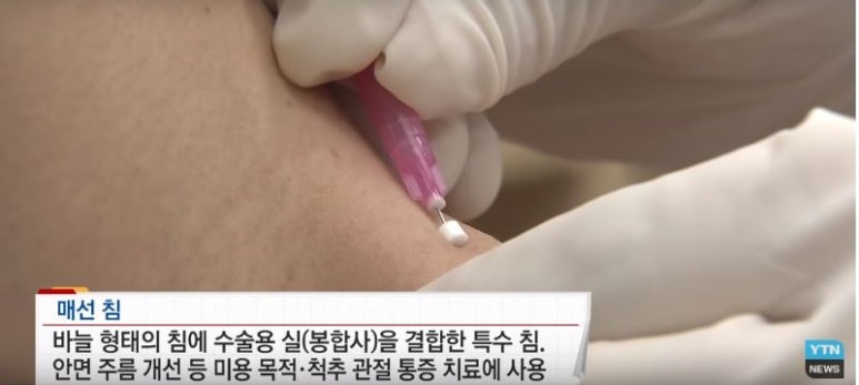 목 통증에 효과적인 매선침, 국제학술지에 발표된 진통 효과 [서울 화곡역 한의원]