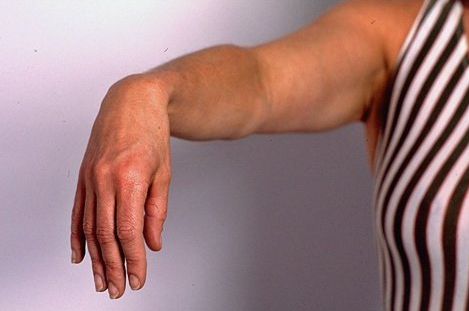 손목이 아프고 안움직여요. 손목통증, 손목마비, 요골 신경 마비 [화곡역 한의원]