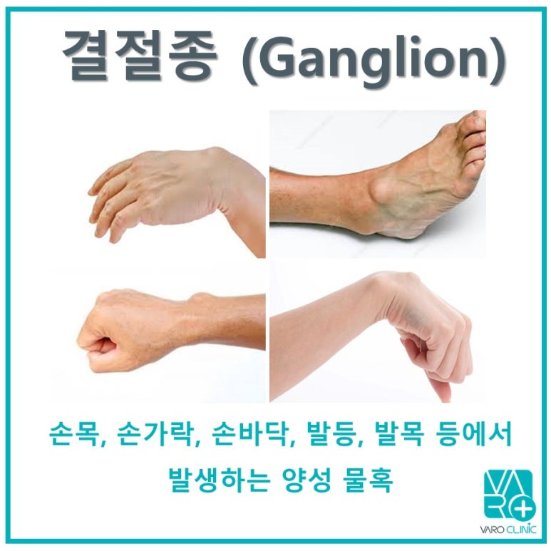 손목, 손가락에 물혹이 생겼어요. 수술 해야하나요? [손목 결절종, 발등 결절종]