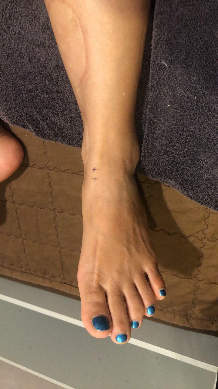 발목 앞쪽이 아파요. 발등 건초염 [강서구 화곡동 한의원]