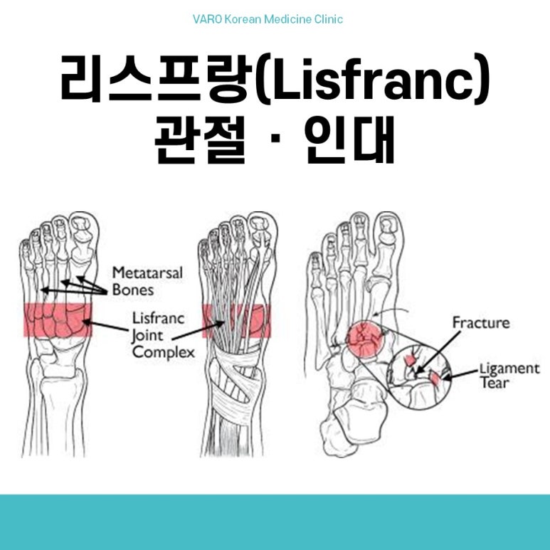 리스프랑 인대 파열, <이것> 모르면 후회합니다.