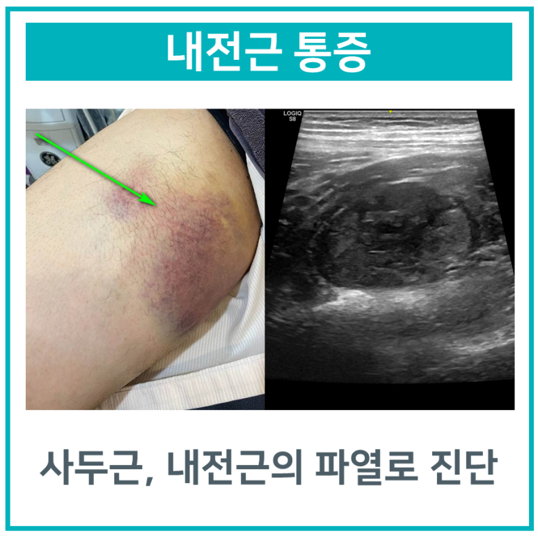 허벅지 앞쪽 대퇴사두근, 안쪽 내전근 통증 & 파열. 무리한 스트레칭은 금물