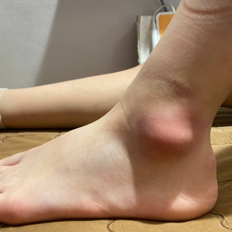 복숭아뼈 부음, 물혹의 원인과 치료방법 [복숭아뼈 점액낭염, 무릎 점액낭염]