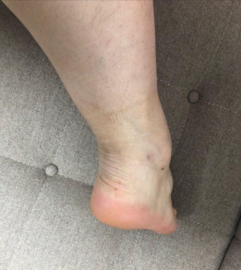 발목 뒤쪽 뒷꿈치가 아파요. 아킬레스 건염, 건증, 석회화, 점액낭염 치료 [한의원]