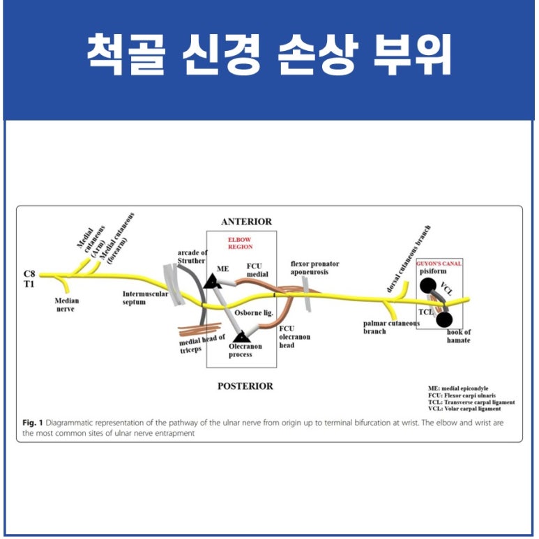 팔꿈치 안쪽 통증, 척골 신경 마비는 MRI 검사가 필요합니다