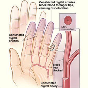 손끝이 하얘지고 아파요! 레이노드 현상 [레이노드 증후군 한의원]