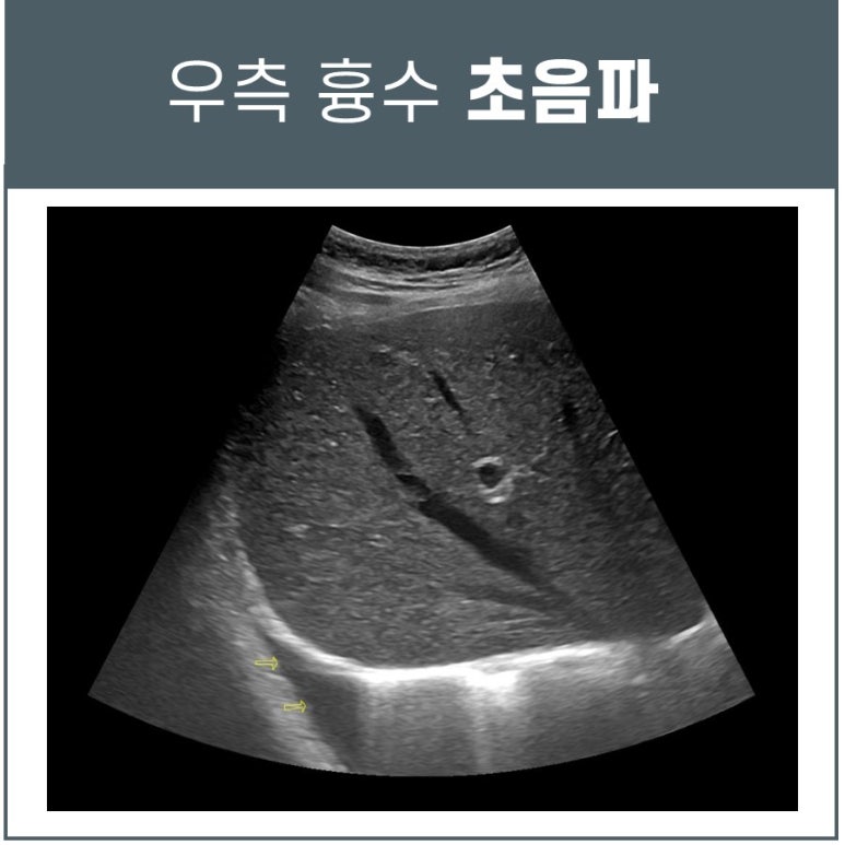 결핵성 늑막염 증상, 단순 근육통이 아닐 수 있습니다