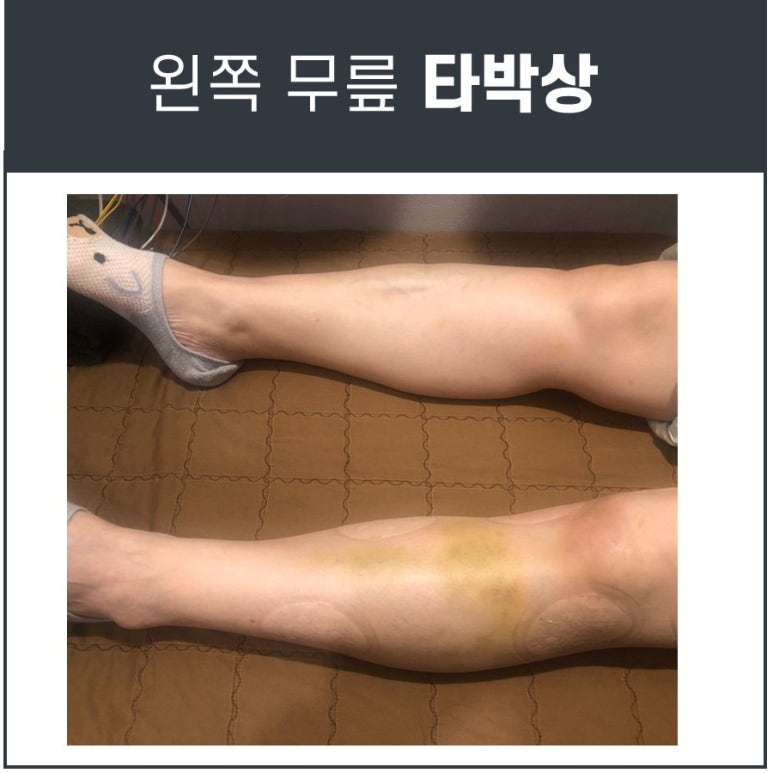 [무릎 타박상, 무릎 멍] 낫지 않는다면? 초음파, MRI 검사가 필수