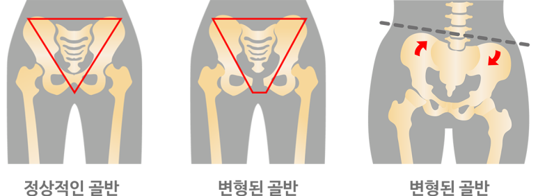 추나 교정, 척추 교정 치료! 건강보험으로 치료받으세요 [화곡역 추나 한의원]