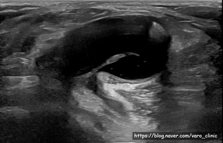 무릎 오금 부위에 혹이 생겼어요. 슬와낭종, 베이커낭종 치료 (Baker's cyst)
