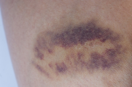 넘어지고 난 후 멍이 들고 아픈데, 근육이 파열된 건가요? (Fat fracture, 지방 골절)