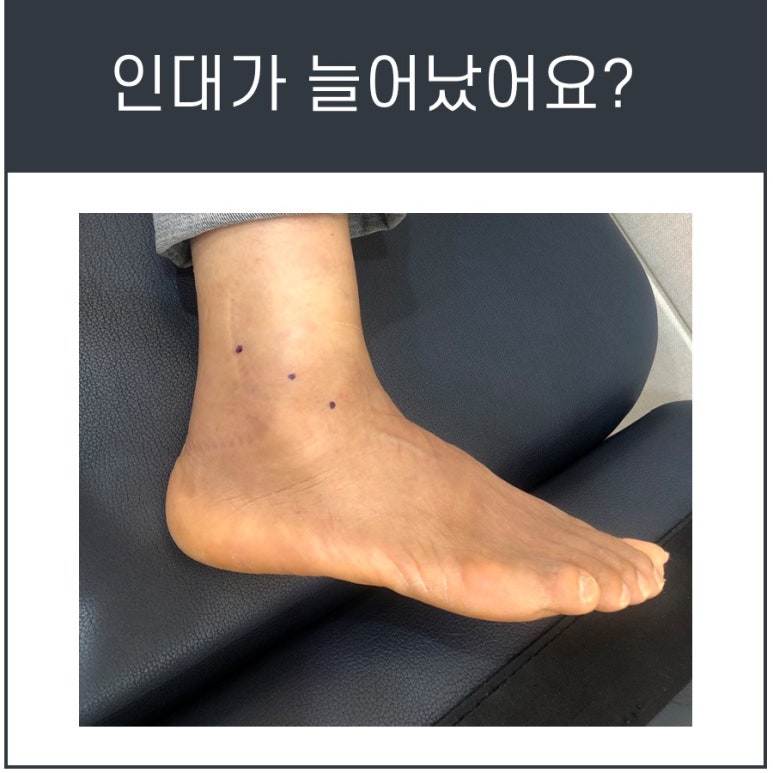 발목 골절, 꼭 수술해야 하나요? [비골 골절의 Weber 분류]