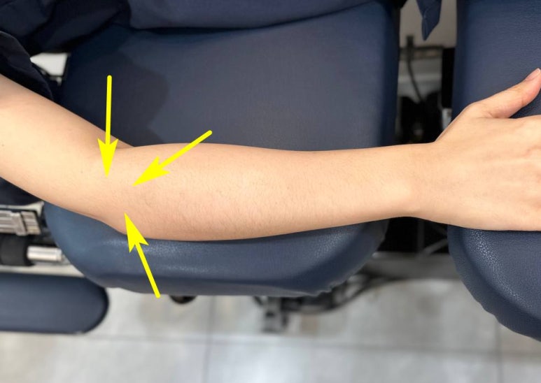 [경혈 초음파] 만성 테니스 엘보우, 초음파 유도하 전기 침 치료 효과