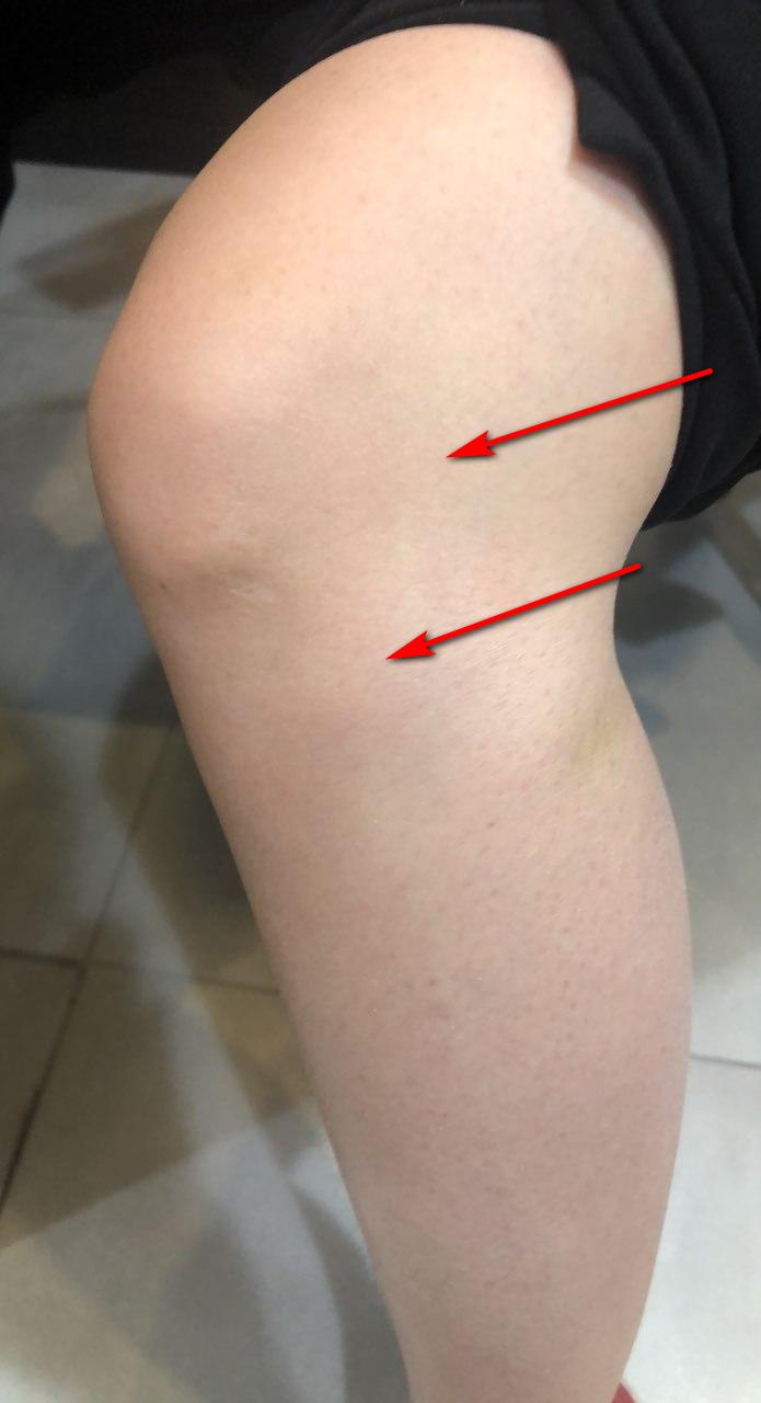 무릎 바깥쪽이 아파요. 장경인대 증후군 외측 통증 [화곡역 한의원]