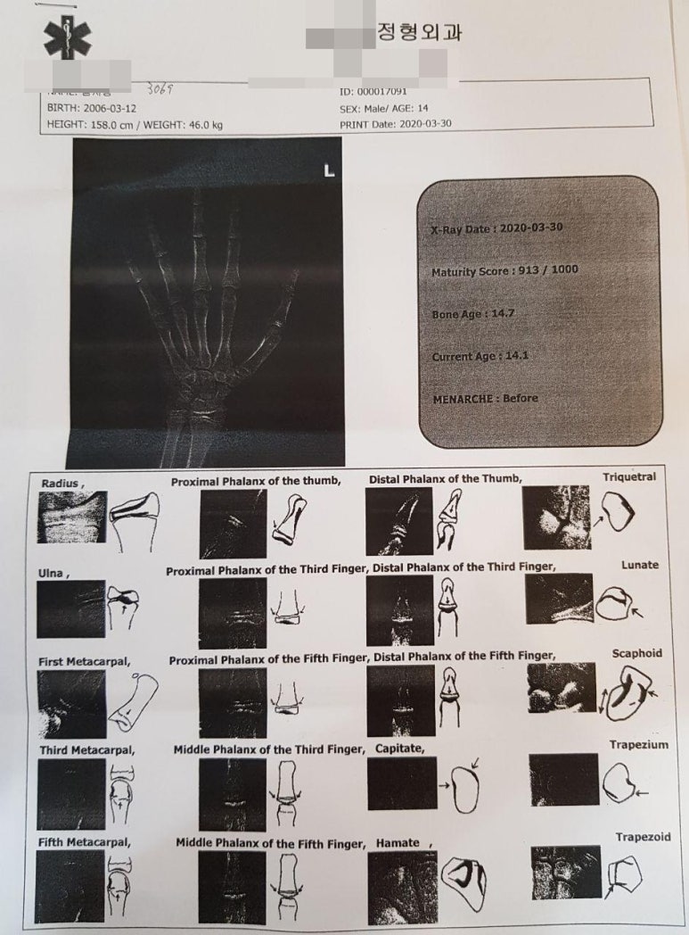 키 성장 한약 + 척추 교정 추나, 치료 후기 [화곡역 소아과]