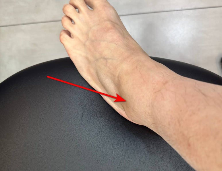 발목인대파열 늘어났을때 통증 증상, <이것>으로 해결될 수 있습니다