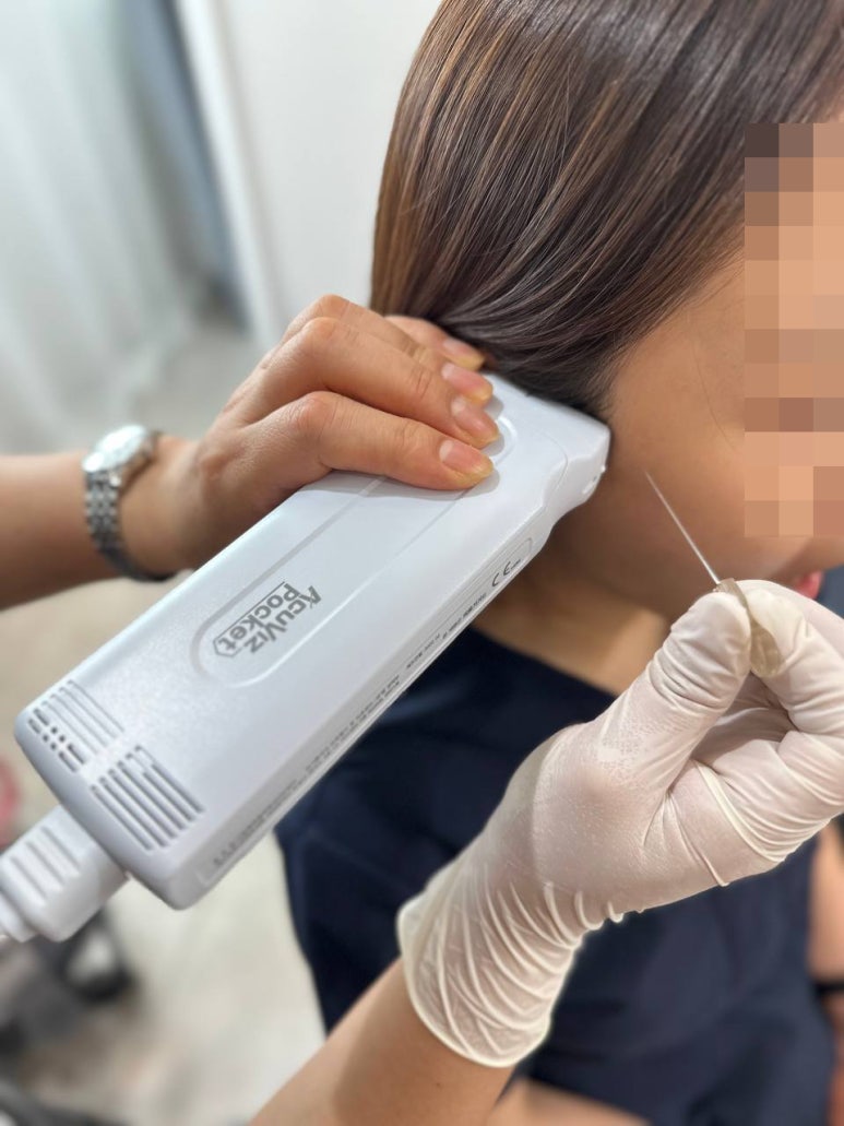 혈관운동성 비염, 초음파 유도하 침 치료가 효과적