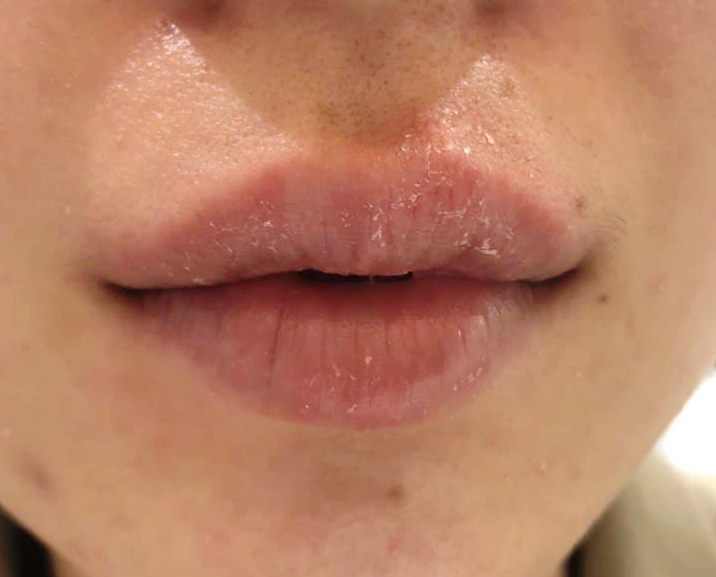 입술 수포 물집 원인은? 헤르페스 예방법 주의사항