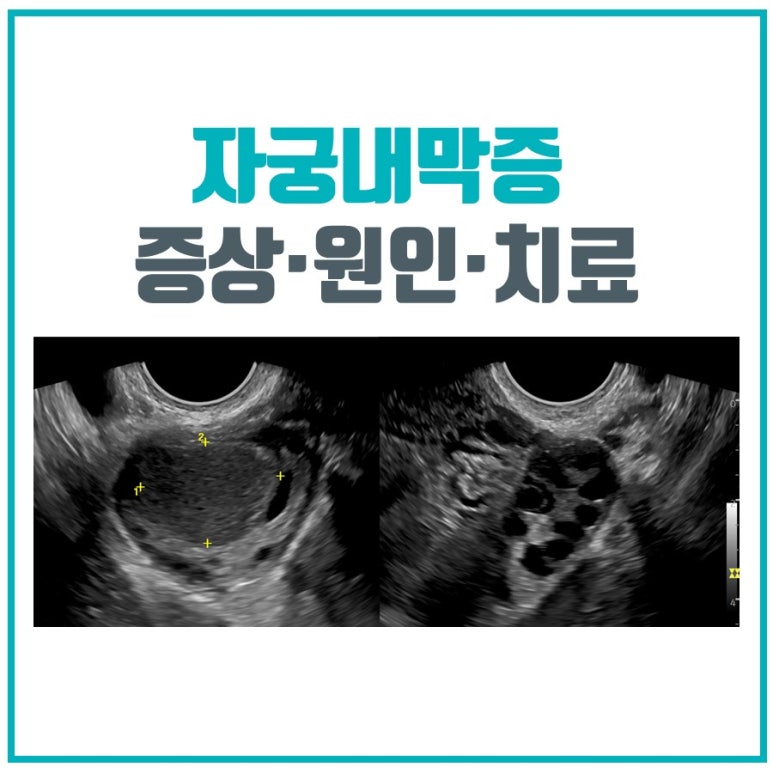 자궁내막증 증상, 원인 및 치료 (난소 자궁내막종)