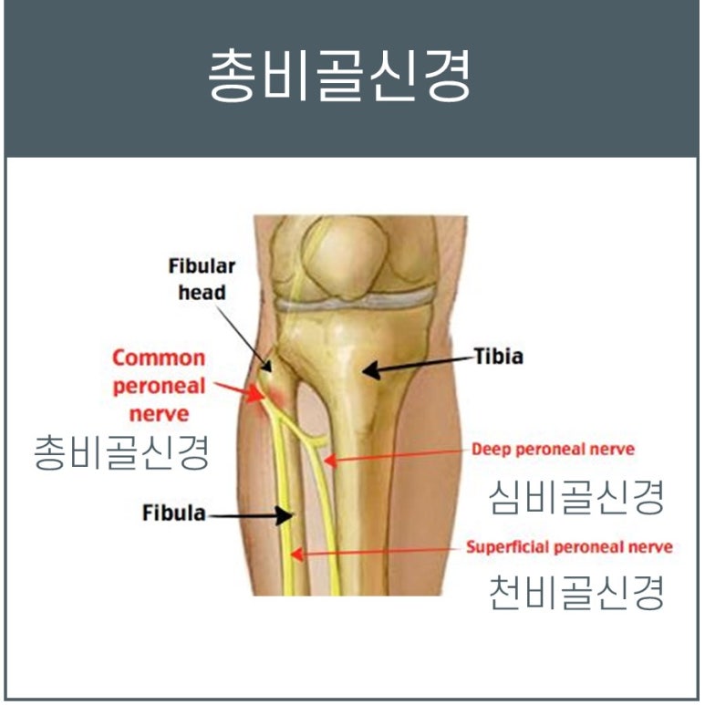 비골신경 마비, 한의원에서 치료하세요!