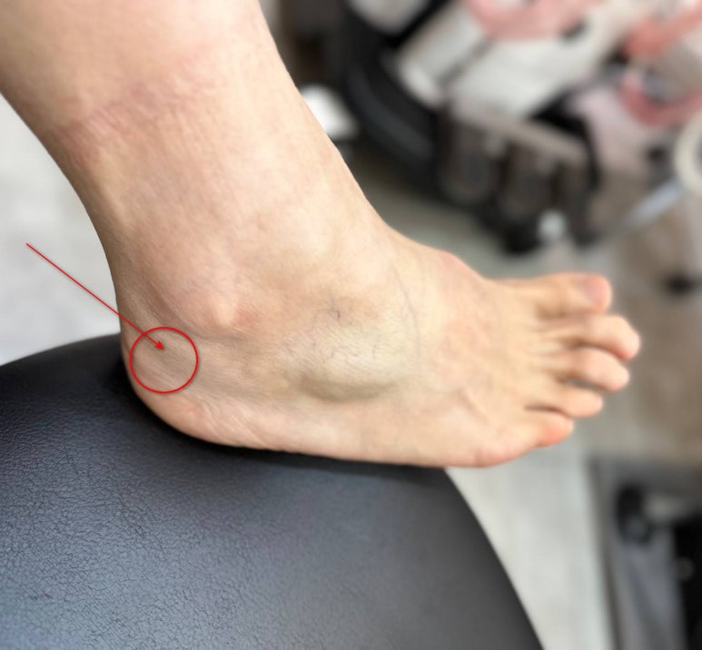 발목 뒤쪽 통증, 12년간 1천명 치료했던 노하우 공개합니다.