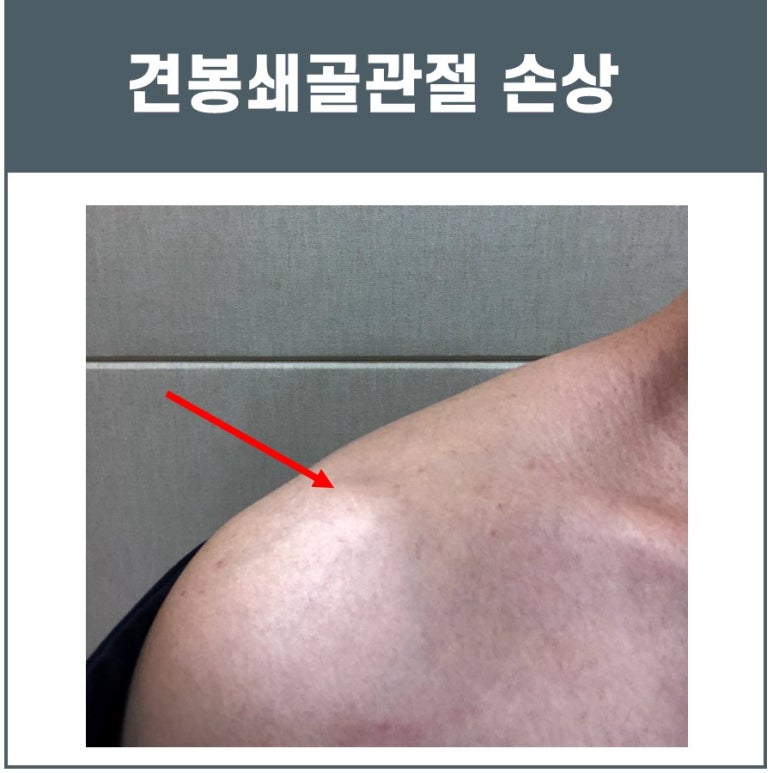 견봉쇄골관절염, 견쇄관절염 MRI 검사가 필요합니다