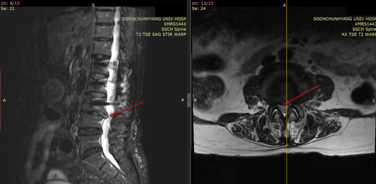 강서구 척추 디스크 한의원, <이것>을 모르면 후회합니다
