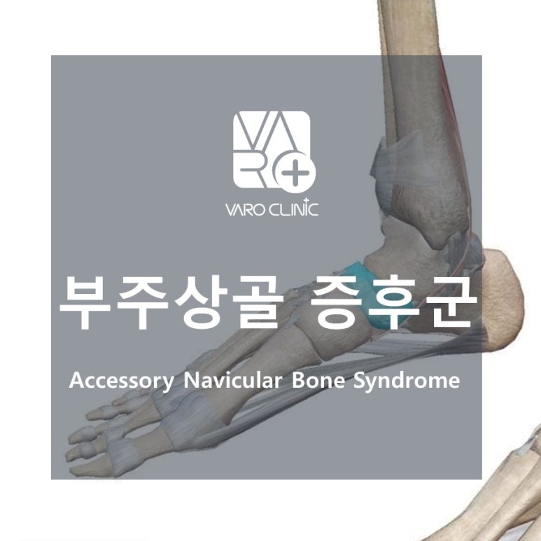 발바닥 통증, [부주상골 증후군] 들어보셨나요?