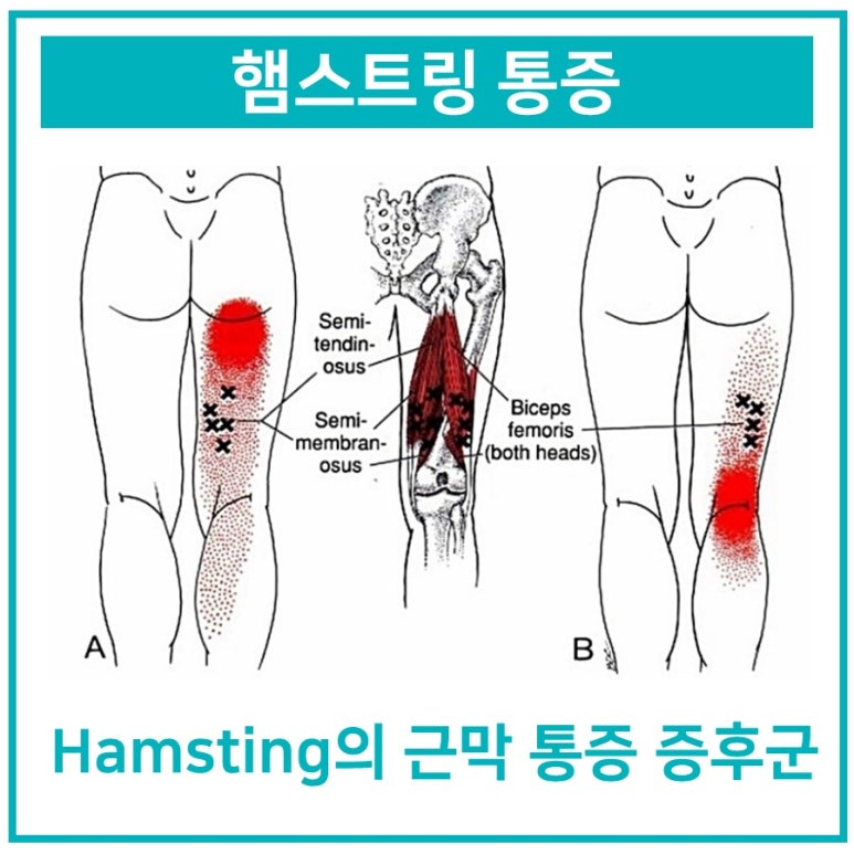 [햄스트링 파열] 아프다고 스트레칭하지 마세요.
