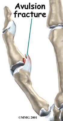 발목 인대파열시 동반되는 견열골절 진단, 우장산역 화곡역한의원