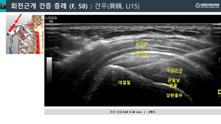 어깨 회전근개 파열, 수술 전 꼭 읽어보세요.