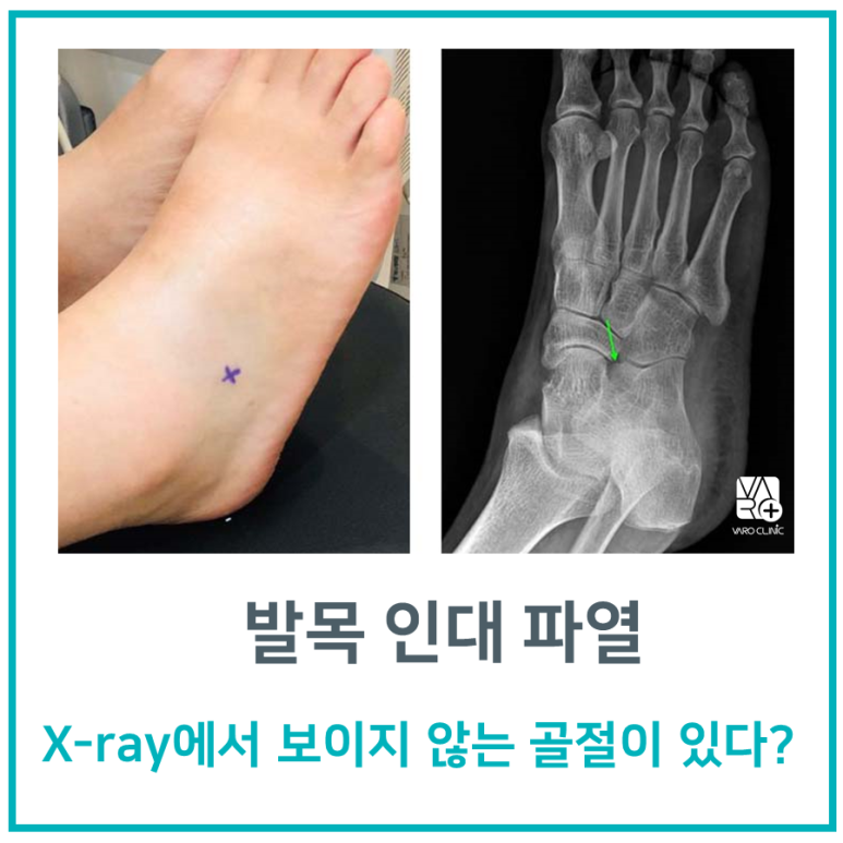 발목 접질렀을때, 미세골절과 인대 파열이 X-ray에서 안 보인다고?