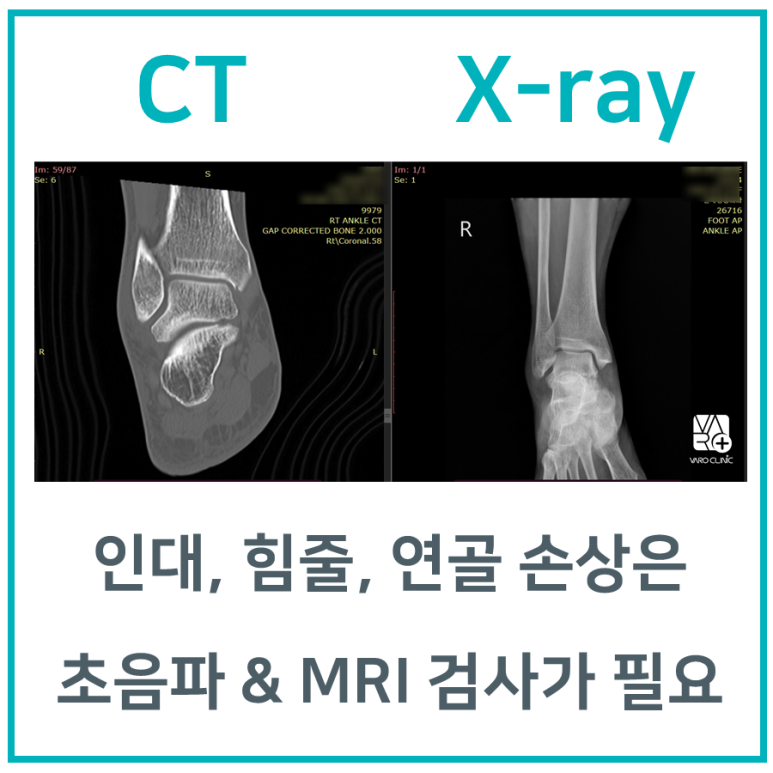 발목 부었을 때, 초음파 & MRI검사가 필요합니다