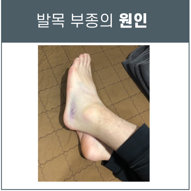 발목 불안정성, 종비인대 파열 [MRI, 초음파가 필요합니다]