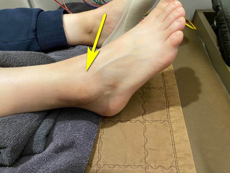 발목인대 늘어났을때, 얼마나 치료해야하나요? [전거비인대, 종비인대 발목염좌 한의원]