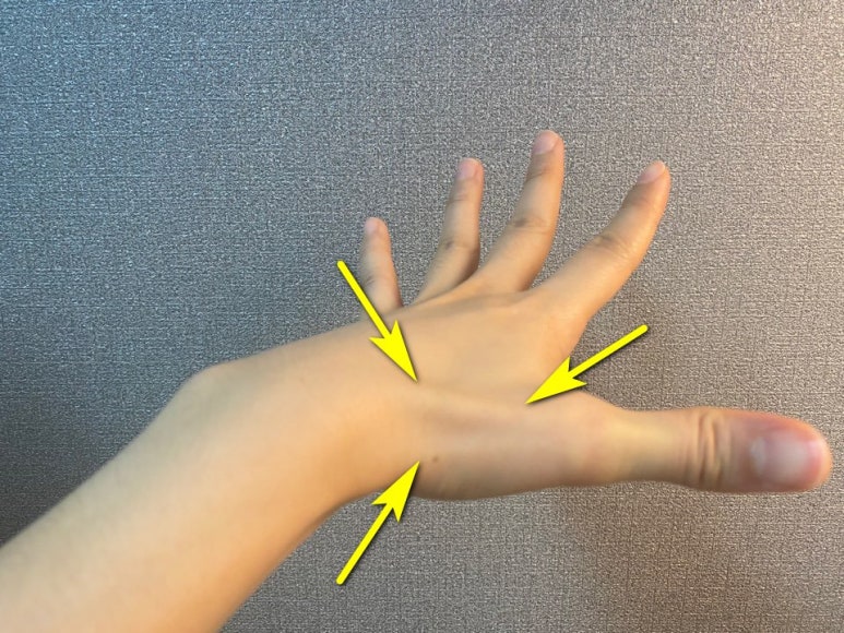 [경혈 초음파] 손목통증 드퀘르뱅 건초염의 도침 (침도) 치료