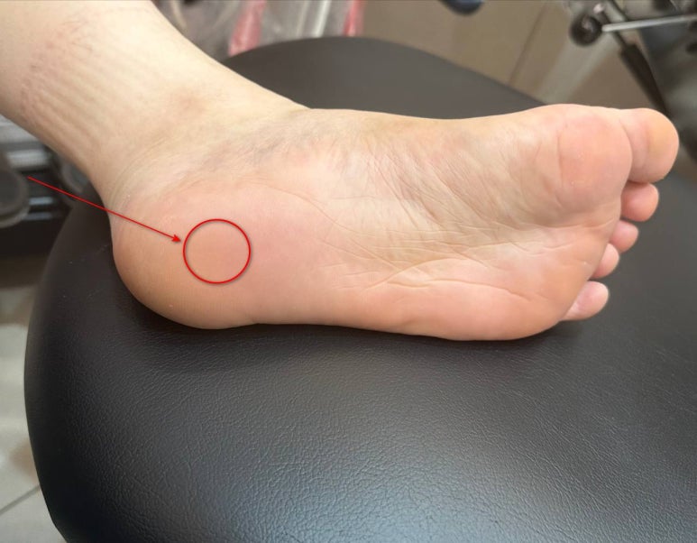 발바닥 통증, 족저근막염, 발바닥 지압? 현직 한의사가 정리해드립니다