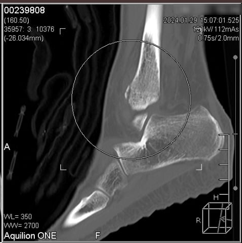 교통사고 발목 발등 통증? 안 낫는다면 반드시 체크해야 할 Tip
