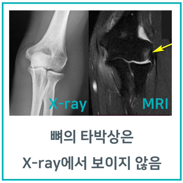 뼈 타박상, MRI 검사가 필요합니다. [화곡역한의원]