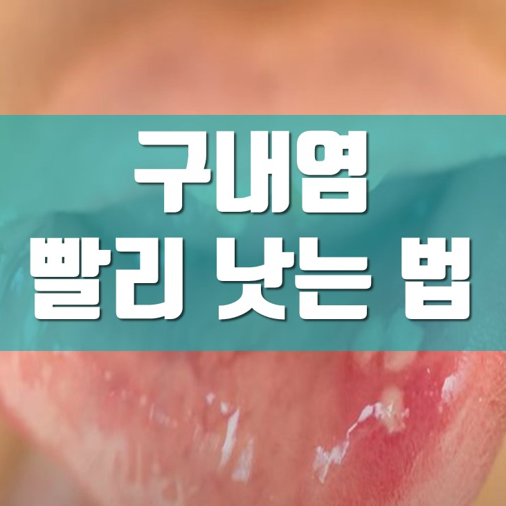 구내염 빨리 낫는 법