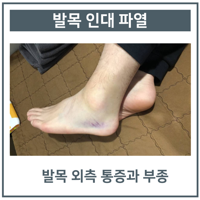 발목인대 늘어났을때, MRI 정밀검사 후 한방치료가 효과적